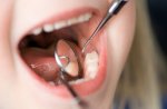 Prevenção em Odontologia – Selantes